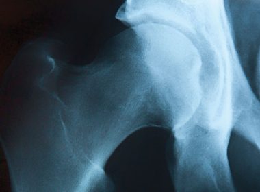 x-ray of bones